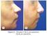 Liberação do músculo depressor do septo nasal para tratamento do sorriso gengival