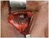 Reconstrução de fratura de assoalho orbital com uso de enxerto autógeno de cartilagem auricular: relato de caso