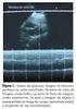 A ultra-sonografia diagnóstica (modo B) na avaliação pós-operatória das cirurgias vítreo-retinianas