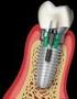 OSSEOINTEGRAÇÃO DE IMPLANTES APÓS LEVANTAMENTO DO ASSOALHO DO SEIO MAXILAR COM OSSO BOVINO INORGÂNICO: ESTUDO CLÍNICO, RADIOGRÁFICO E HISTOLÓGICO.