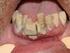 Efeito do tratamento periodontal na condição do periodonto e na atividade inflamatória sistêmica em portadores de lúpus eritematoso sistêmico