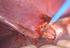 Passagem de células endometriais para a cavidade peritoneal durante histeroscopia diagnóstica