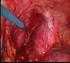 Cirurgia laparoscópica no cancro do cólon