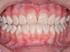 Microabrasão do esmalte dental para tratamento de fluorose
