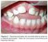 Prevalência de trauma dental em crianças atendidas na Universidade Federal do Ceará