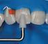 THE INFLUENCE OF RUBBER DAM ON THE SUCCESS OF CLASS II ATRAUMATIC RESTORATIVE TREATMENT (ART) RESTORATIONS IN PRIMARY TEETH