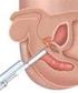 Biópsia Prostática O Valor do PSA, Toque. Rectal e Ecografia Transrectal
