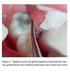 Aspectos clínicos da utilização do gel de papaína e cloramina na remoção da cárie dentária