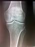 OSTEOTOMIA TIBIAL ALTA EM PACIENTES COM ARTROSE DO JOELHO