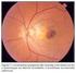 Epidemiologia das Perdas do Globo Ocular por Retinoblastoma. Eyeball Loss Epidemiology by Retinoblastoma