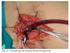 Proteção medular em cirurgia da aorta descendente com uso de bio-pump e exsangüinação controlada