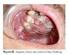 Estudo epidemiológico do carcinoma epidermóide de boca no estado de Sergipe