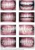 Análise da discrepância de tamanho dentário em pacientes da Clínica de Ortodontia da FO/UERJ