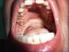 Prevalence of oral diseases: a 15-year follow-up
