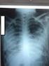 Insuficiência respiratória aguda como primeira manifestação de esclerose lateral amiotrófica: dois casos clínicos