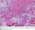 Fibrose pulmonar idiopática: comparação de dados clínicos e funcionais em pacientes com e sem faveolamento.