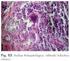 INFILTRAÇÃO LINFOCÍTICA NO PARÊNQUIMA DA GLÂNDULA SALIVAR PARÓTIDA DE RATOS DIABÉTICOS SUPLEMENTADOS COM ACETIL-L-CARNITINA