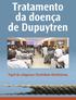 Tratamento da doença de Dupuytren