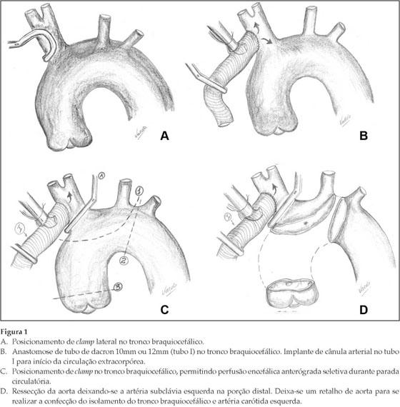 24 A aorta é seccionada após a interrupção da perfusão sistêmica, deixando tecido aórtico suficiente para o isolamento do TBC e carótida esquerda (Figura 1D).