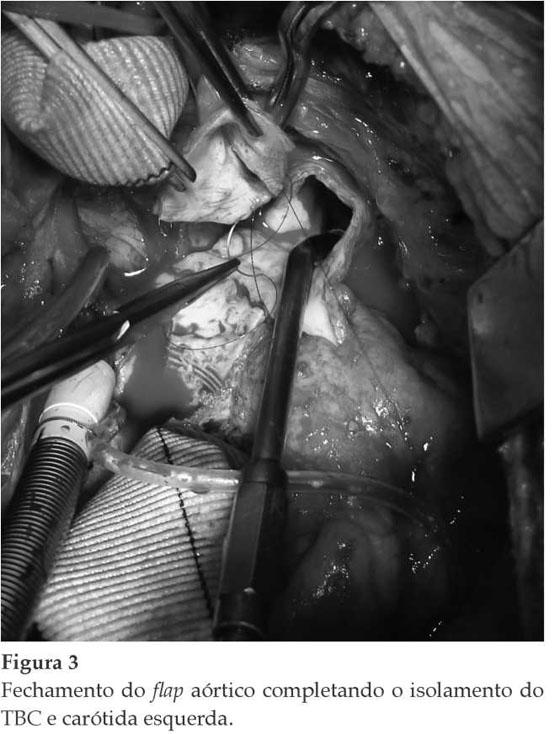 26 e Figura 5). A cânula colocada no enxerto do TBC (tubo I) é removida, deixando a perfusão apenas pela cânula colocada na prótese aórtica (tubo II).