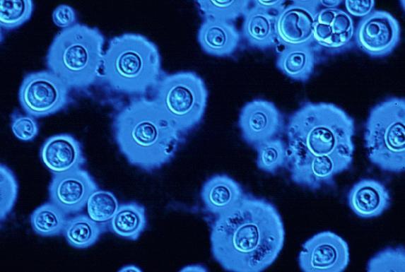 Criptococose Cryptococcus neoformans A criptococose é a micose de caráter sistêmico mais freqüente em