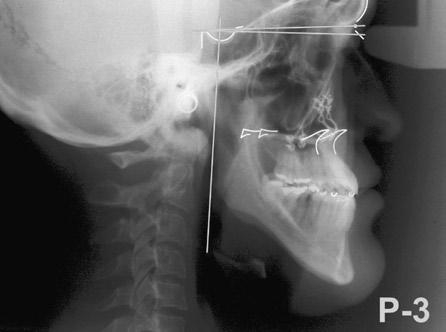 Estabilidade do reposicionamento anterior da maxila através de análise cefalométrica lateral de dois furos, na região de pilar zigomaticomaxilar, em ambos os lados.