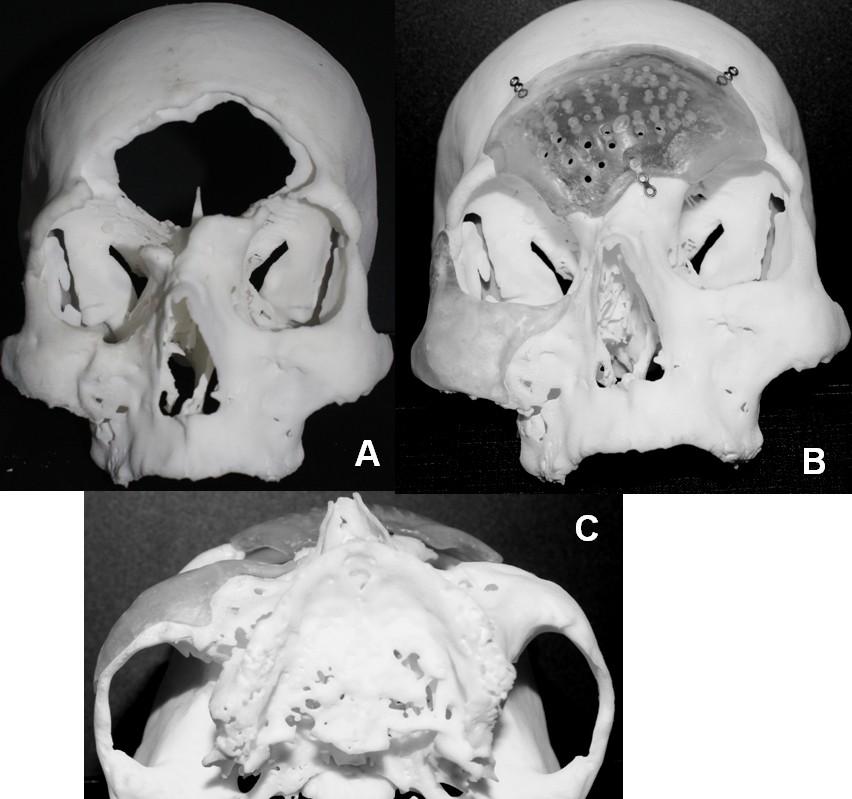 12. Figura 3:Protótipo que demonstra condição real em 3D do paciente (A). Próteses frontal e zigomática, customizadas em PMMA moldadas no protótipo (B) e (C).