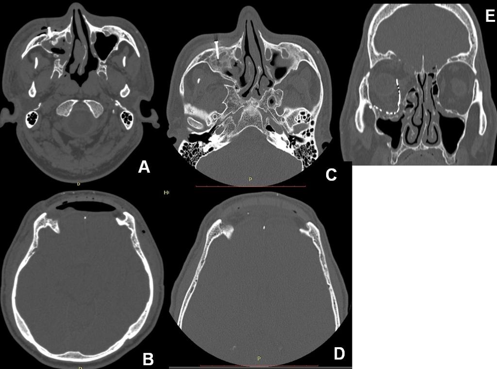 15 Figura 5: Tomografia computadorizada pós-operatória imediata em A e B, tomografia computadorizada pós operatória de um ano em C, D e E No pós-operatório imediato, foi realizado antibioticoterapia