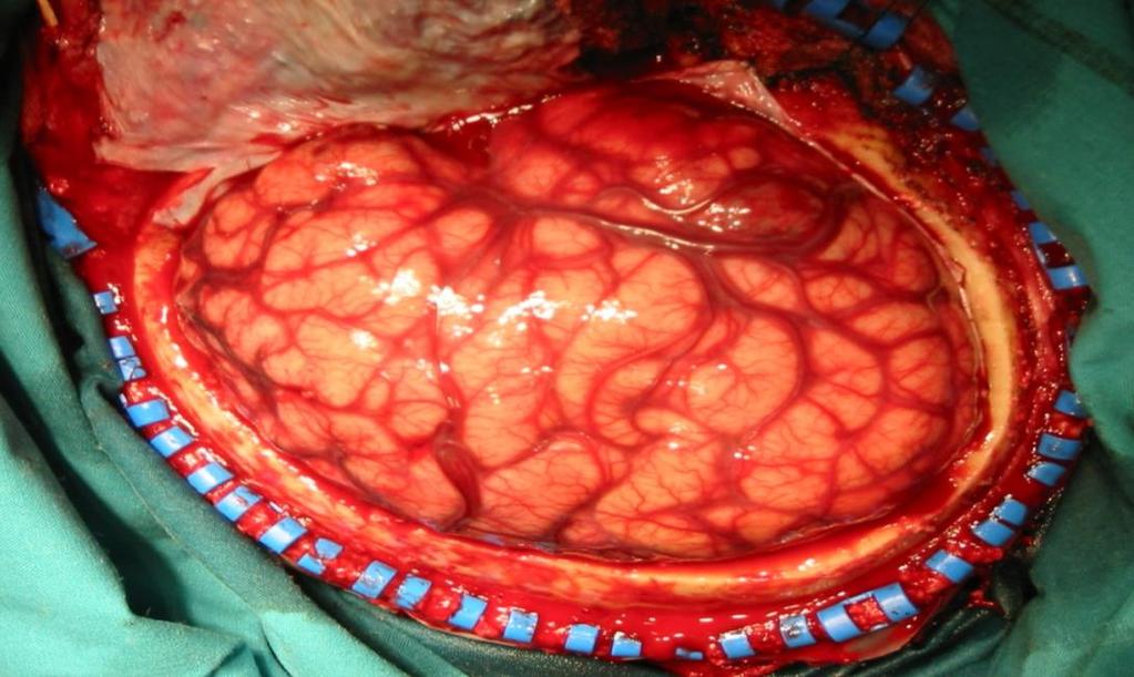 Craniectomia descompressiva Objetivos : Transformar a caixa craniana em um compartimento