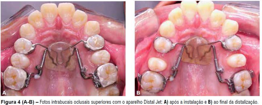 que é inserida na caixa lingual da banda do primeiro molar. Um fio-âncora partindo do botão de Nance é soldado às bandas dos segundos pré-molares.