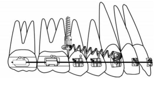 movimentação dental. Villela et al. (2008) preconizaram a utilização de mini parafusos ortodônticos, como ancoragem absoluta, para obtenção da distalização de molares sem a colaboração do paciente.