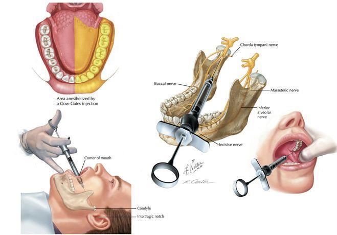 Anestesia