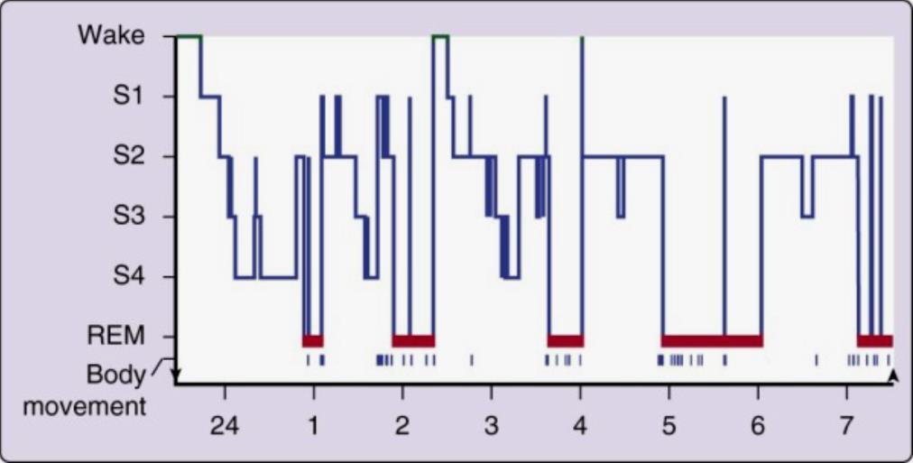 medida que o episódio de sono avança, a fase 2 começa a constituir a maioria do sono NREM e as fases 3 e 4 podem, por vezes, desaparecer completamente (1). Figura 4.