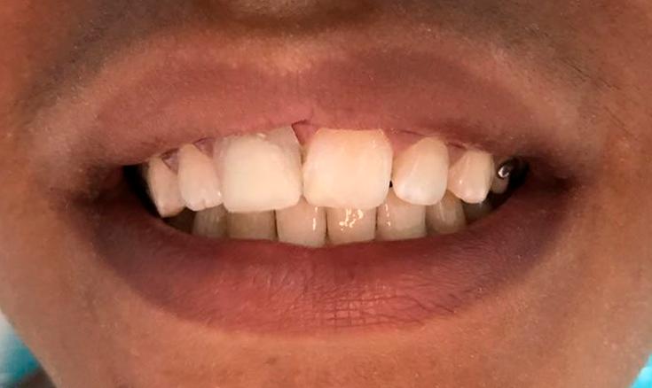 radioluscência periapical, pequena deposição de tecido mineralizado no interior do canal radicular, porém sem diferença no tamanho da raiz ou na espessura das paredes de dentina.