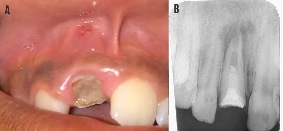 Figura 9 A. Fístula após o tratamento B.