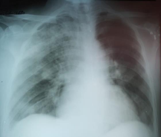 Figura 01- Radiografia de tórax: opacidade de segmento superior