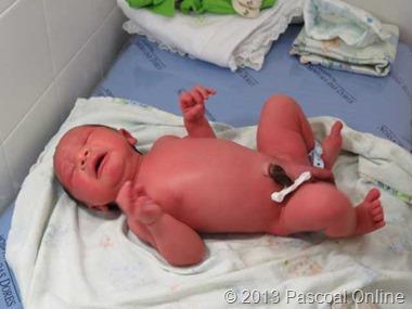 PERÍCIA DO INFANTICÍDIO Logo ao nascer (infante nascido) Cordão umbilical úmido, brilhante e de cor azulada Pode haver mecônio, substância