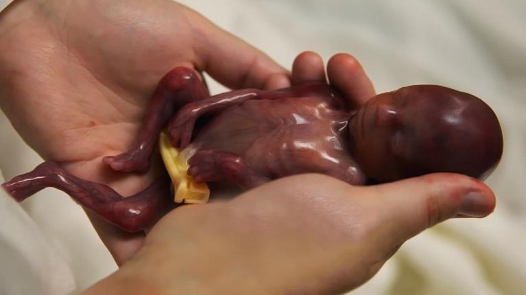 ABORTO É a interrupção da gravidez, com morte do feto, em qualquer fase da gestação.