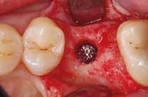 O objetivo do tratamento consistia então em reabilitar o dente 26 seguindo a abordagem de enxerto do assoalho crestal indireto por meio de implante imediato usando Geistlich Bio-Oss Collagen.