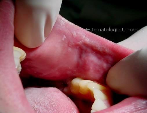 Figura 2 (Clínica de Estomatologia da Unioeste Cascavel/PR): Lesões semelhantes a fissuras, com coloração esbranquiçada, difusa, em região de mucosa jugal esquerda, próximo à comissura labial.