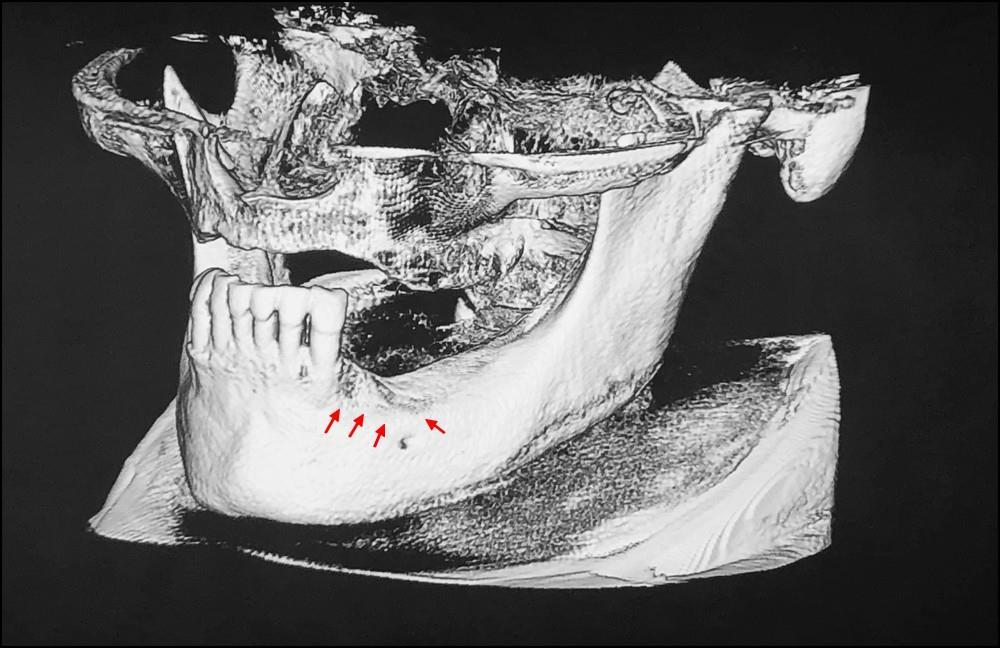 13 Figura 5: Reconstrução em 3D. Evidenciação de anormalidade em suporte ósseo delimitada pelas setas vermelhas.