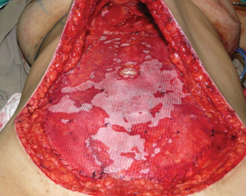 aponeurose do músculo oblíquo externo e reto abdominal (Figura 3). Foi feita uma abertura na tela de polipropileno por onde se exteriorizou o umbigo.