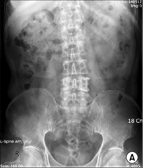 AVALIAÇÃO DO CONTEÚDO ABDOMINAL RADIOGRAFIA SIMPLES DE ABDOME: - Atenção sistemática: ossos, tecidos moles, bases pulmonares, órgãos