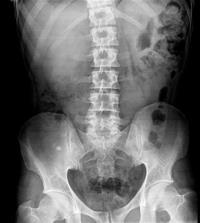 AVALIAÇÃO DO CONTEÚDO ABDOMINAL RADIOGRAFIA SIMPLES DE ABDOME: - DISTRIBUIÇÃO DOS GASES Pontos de referência (bolha gástrica, bulbo duodenal,