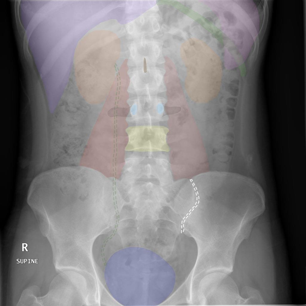 RADIOLOGIA DO ABDOME ABDOME AGUDO NÃO