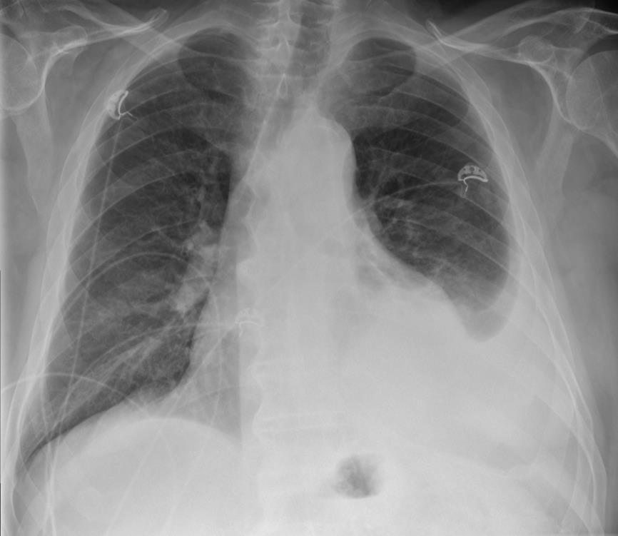 Por que é feita radiografia de tórax?