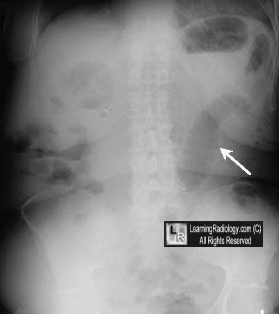 buscados nas radiografias quando da suspeita de abdome agudo: