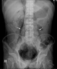 agudo: - Retropneumoperitônio: ar no espaço