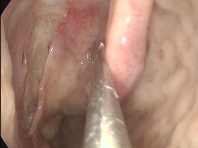 TPCM: terço posterior da concha nasal média (lamela basal horizontal da concha nasal média). CI: concha nasal inferior. C: arco da coana. PU: processo uncinado.