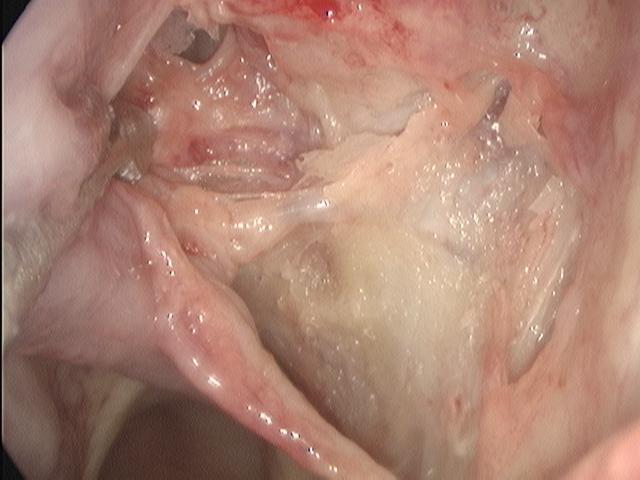 *retalho mucoperiosteal do terço posterior da concha nasal média (lamela horizontal da concha nasal média) medializado. esf: parede anterior do seio esfenóide. E CE C * LPOP S Figura 11.